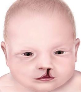 Drawing of a baby with a damaged mouth